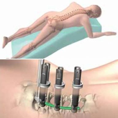 OLIF · Dr.Gómez Rice