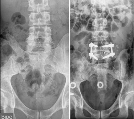 RX Artrodesis lumbar
