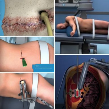 OLIF · Dr.Gómez Rice