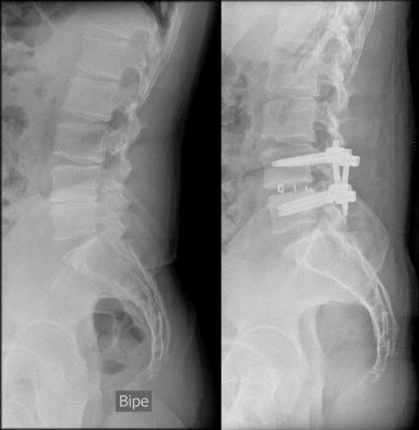 RX Artrodesis lumbar